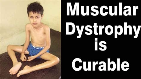 Muscular Dystrophy Treatment Successful Treatment Of Muscular