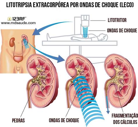 TRATAMENTO DO CÁLCULO RENAL Litotripsia Cirurgia e Duplo J MD Saúde