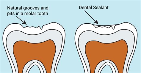 What Are Dental Sealants North Carolina Oral Health Collaborative