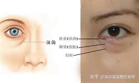 泪沟越来越“年轻化”？教你3种方法改善它！ 知乎