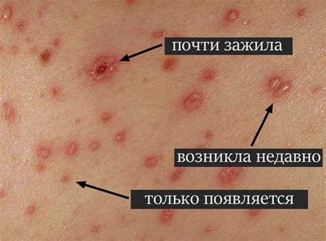 Средства от зуда и высыпаний при ветрянке