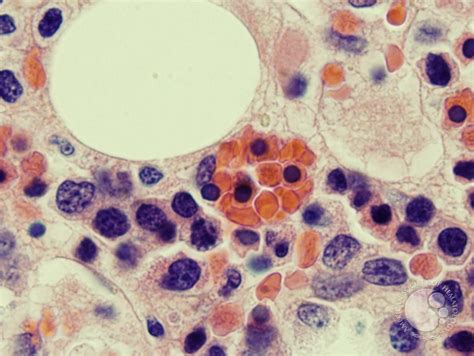 Hemophagocytosis Bone Marrow Biopsy Of Patient With Hepatitis C And