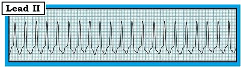 Ecg Interpretation Ecg Interpretation Review Narrow Qrs