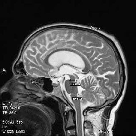 Brain Mri Of The Patient Showing Atrophy Of Midbrain Download