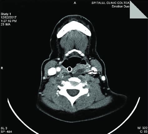 Neck Ct Scan Examination With Contrast Substance Accumulation Of Download Scientific Diagram