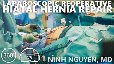 Laparoscopic Reoperative Hiatal Hernia Repair Dr Ninh T Nguyen