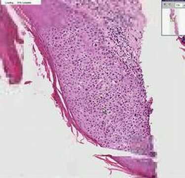 Actinic Keratosis Histology