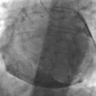 Fluoroscopy showing significant pericardial calcification. | Download Scientific Diagram