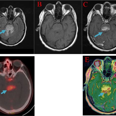 Axial Images At The Level Of Cerebellum Flair F T Wi Mr Pre G