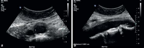 B Mode Ultrasound Imaging At 6 Month Follow Up Using 5 1 Mhz Curved Download Scientific Diagram