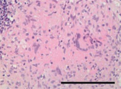 Histological Features Of Intestinal Tuberculosis ITB And Crohns