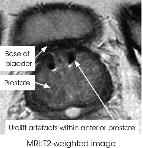 The Urolift System A Progress Report Mcnicholas 2020 Trends In