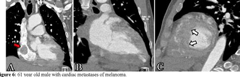 Figure 1 From Cardiac Metastases Of Melanoma As First Manifestation Of The Disease Semantic