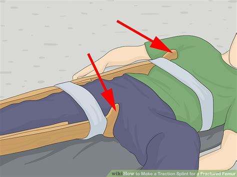 How To Make A Traction Splint For A Fractured Femur 10 Steps