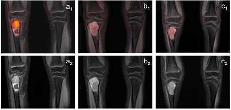 Ewing Sarcoma X Ray