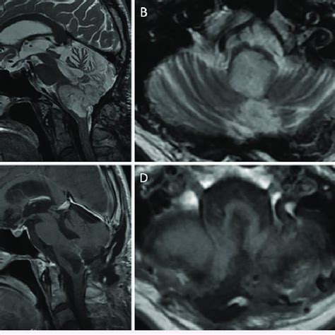 A Preoperative Sagittal T2 Weighted Mri With Gadoliniumbased Contrast