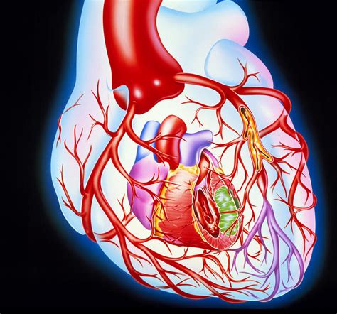 Artwork Showing A Heart With Angina Photograph By John Bavosi