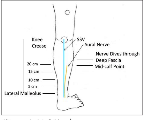 Figure 4 From The Sural Nerve Sonographic Anatomy Variability And