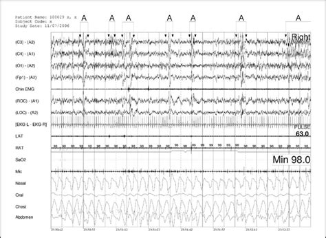 Example Of Recording In A Patient With Upper Airway Resistance Syndrome