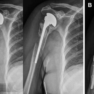 A Type B Periprosthetic Fracture With Obvious Loosening Of The Humeral