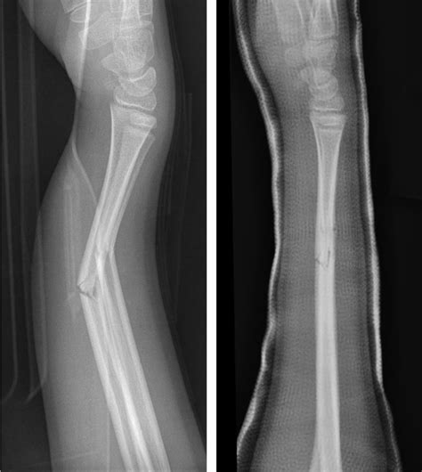 kids forearm fracture raleigh hand surgery joseph  schreiber md