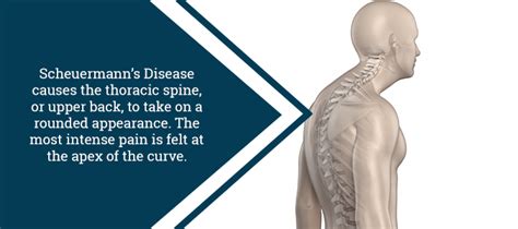 Scheuermanns Disease Disease Scheuermann Kyphosis Symptoms Epainassist