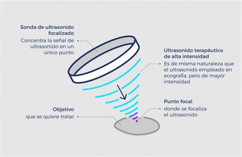 Cómo funciona el ultrasonido