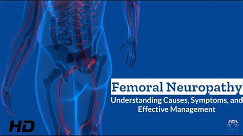 Femoral Neuropathy Unveiled What You Need To Know Youtube