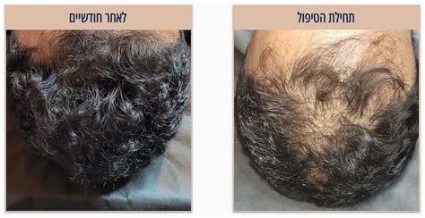 6 דרכים טבעיות לטפל בנשירת שיער - קוסמטיקאית לטיפול בשיער