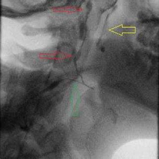 Spot Fluoroscopic Image Demonstrates The G Angiocatheter Green