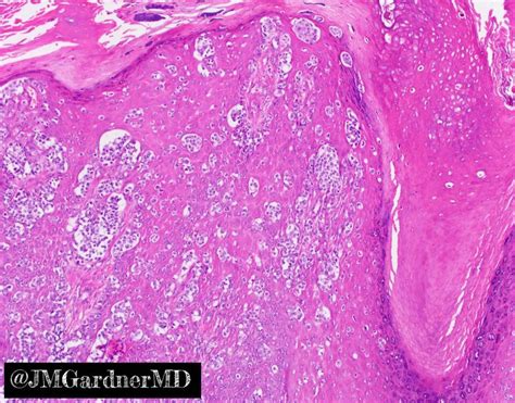 Acral Lentiginous Melanoma Histology