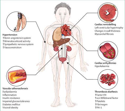 Figure 1 From Complications Of Cushing S Syndrome State Of The Art Semantic Scholar