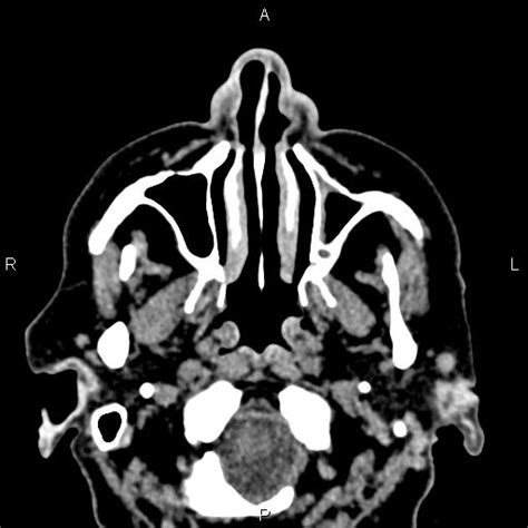 Bilateral Enlargement Of Lacrimal Glands Sarcoidosis Radiopaedia