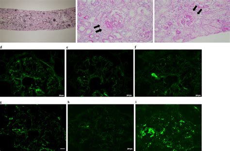 Figure2 Renal Biopsy Findings Of The Present Case A Pam Stain Showing Download Scientific