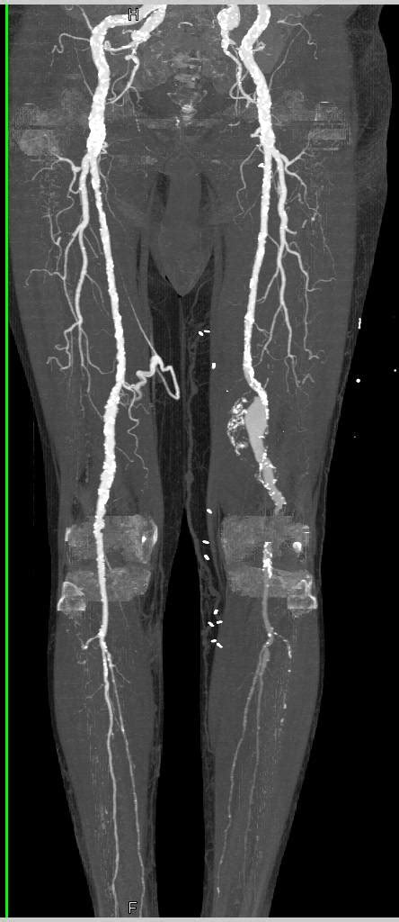 Dual Energy Cta With Peripheral Vascular Disease Vascular Case