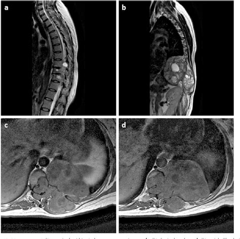 PDF Giant Thoracic Schwannoma Masquerading As Transverse Myelitis