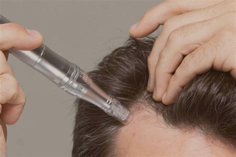 The Benefits Of Microneedling Scalp Treatment Be The Healthier You