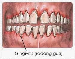 Cara Mengobati Gusi Bengkak Cara Dan Tips Kesehatan