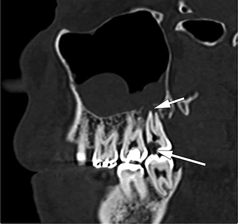 Cross Sectional Imaging Of Third Molarrelated Abnormalities American Journal Of Neuroradiology