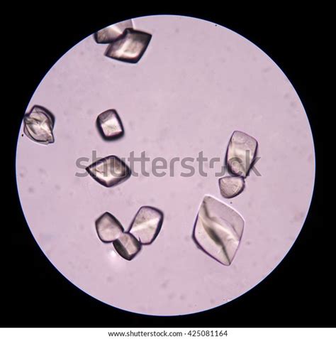 Uric Acid Crystal Urine Sediment Stock Photo 425081164 Shutterstock