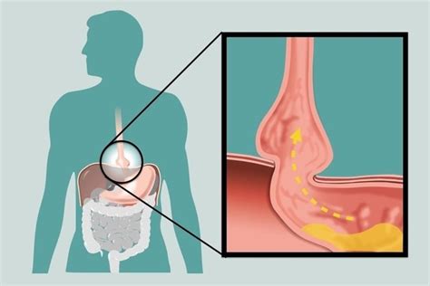 Refluxo Gastroesof Gico O Que Sintomas Causas E Tratamento Tua Sa De