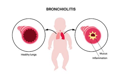 bronchiolitis lung disease stock illustration  image