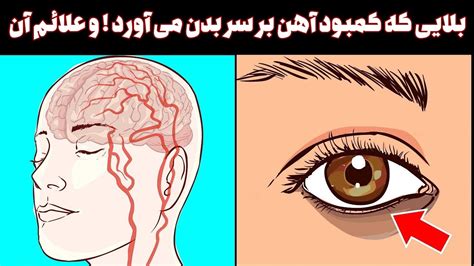 کمبود آهن چه بلایی بر سر بدن می اورد و چگونه باید فهمید که بدن دچار