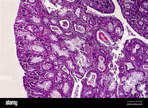 Villous Colon Adenocarcinoma Light Micrograph Photo Under Microscope