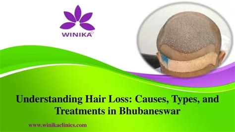 Ppt Understanding Hair Loss Causes Types And Treatments In