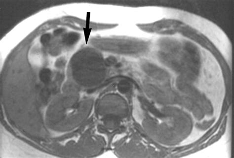 Macrocystic Serous Adenoma Of The Pancreas RadiologicPathologic