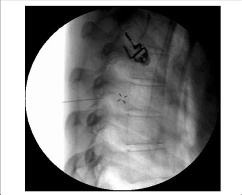 Lateral Fluoroscopic Image Showing Needle Placement For Thoracic Dorsal