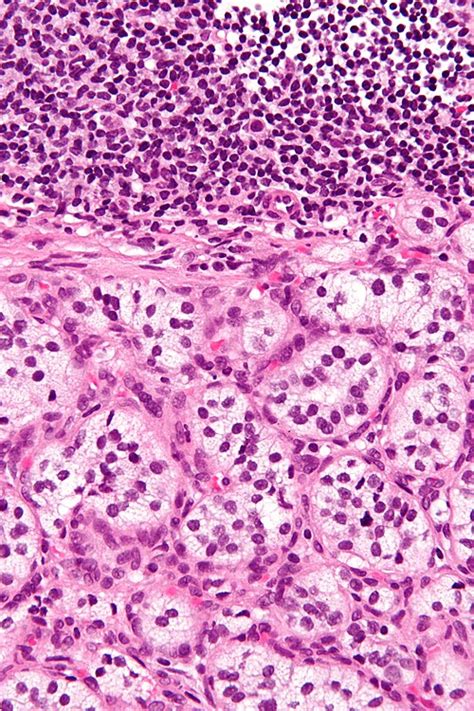 Case 2 Libre Pathology