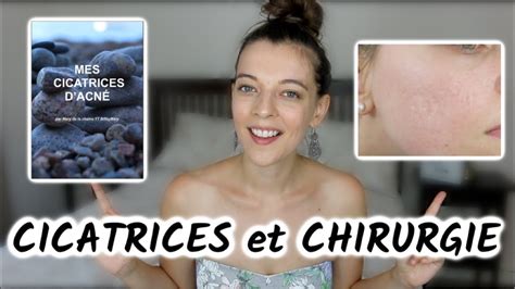 Cicatrices D Acn I Laser Et Chirurgie Ebook Youtube