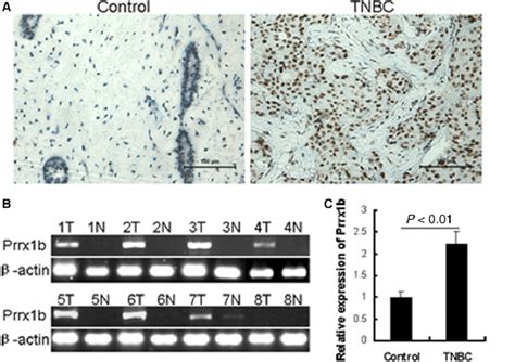 The Prrx B Expression Levels Were Frequently Up Regulated In Tnbc A